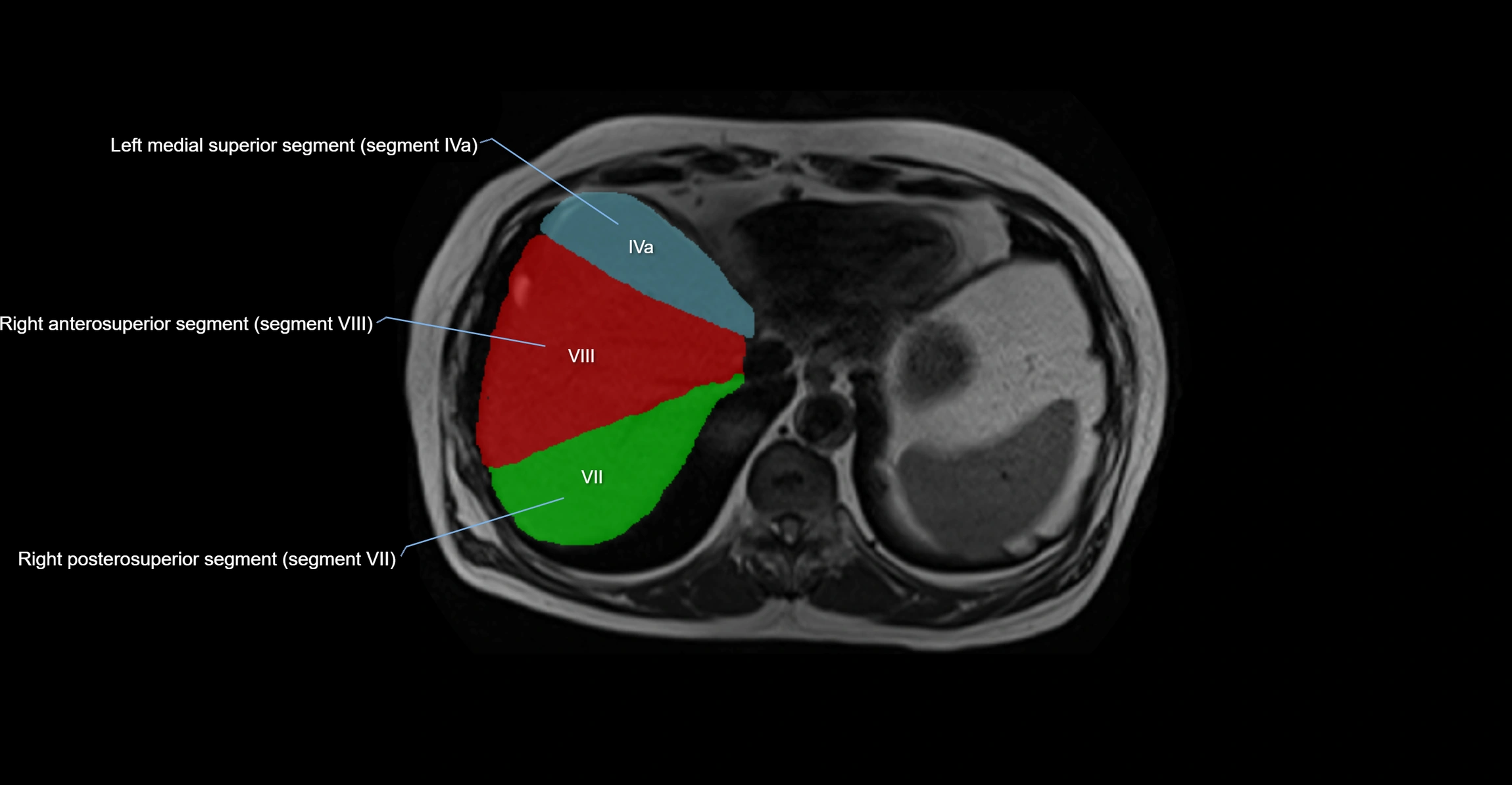 MRI  liver segments anatomy axial cross sectional 3T radiology  image-img-00001-00006.webp